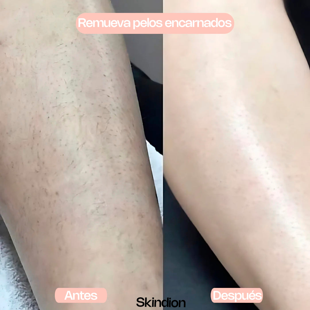 Skindion Smooth - Depilador de Cristal Instantáneo -